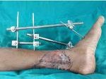 Ankle joint replacement in nashik